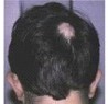 男性型脱毛症1,260万人、毛髪再生医療に期待高まる（上）