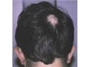 男性型脱毛症1,260万人、毛髪再生医療に期待高まる（上）