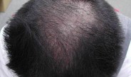 禿げ、薄毛の現代事情（上）～アールテック・ウエノが男性型脱毛症治療薬でライセンス交渉中
