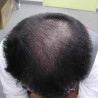 禿げ、薄毛の現代事情（上）～アールテック・ウエノが男性型脱毛症治療薬でライセンス交渉中