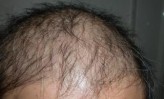 【9】アデランス、抗がん剤の脱毛を予防する産学共同研究スタート（下）